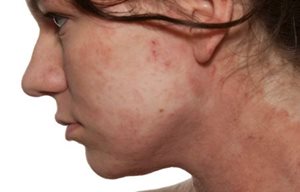 El perfil de una mujer con piel enrojecida en las mejillas.