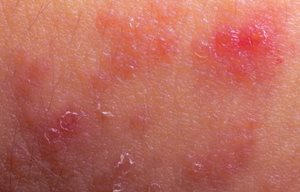 Una piel que luce con una infección descascarada.